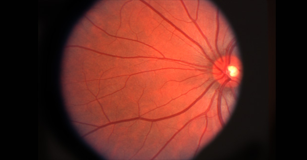 Anti-VEGF-injections-Image