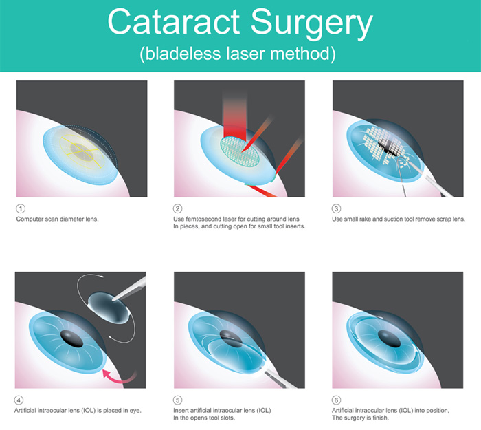 Cataract Surgery Procedure in Buffalo
