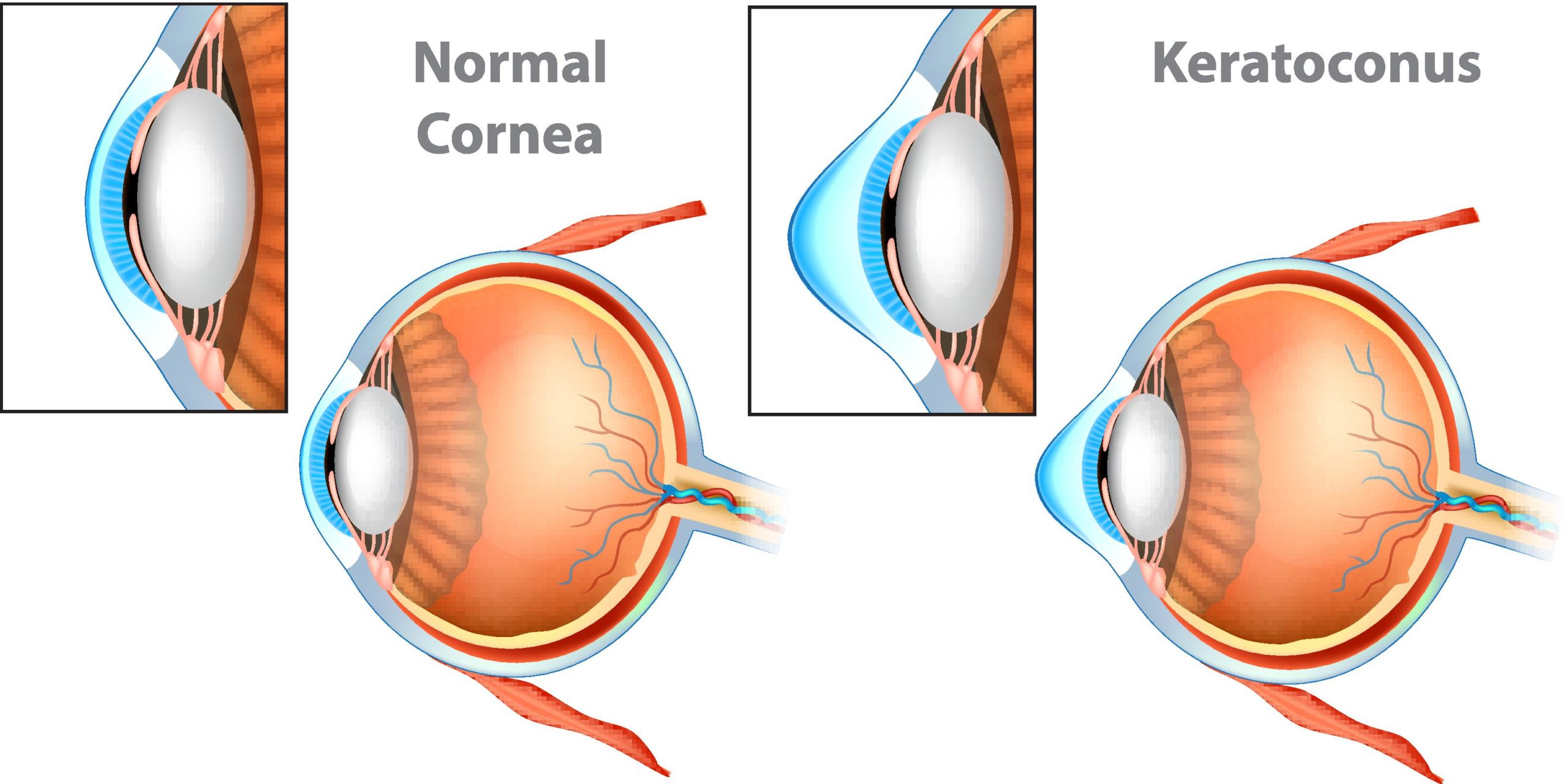 cornea_transplant.eps_3166_1578