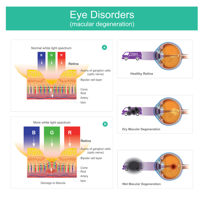 Retinal Diseases Treatment