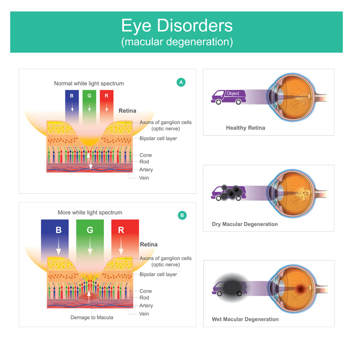 Amsler Grid - Retina Test - Retina Specialist - Buffalo New York - Back of  the Eye MD