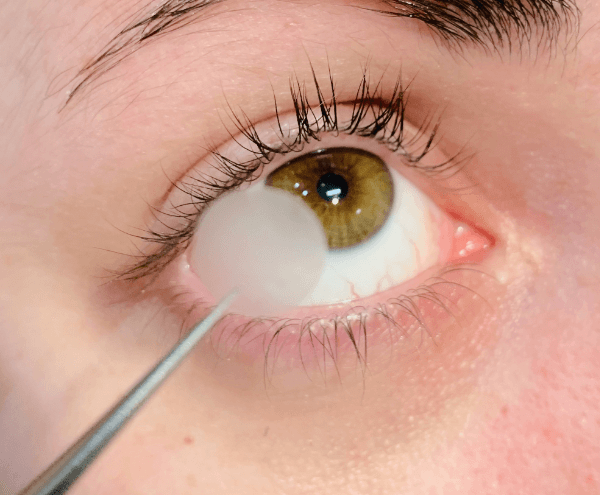 Amniotic Membrane Dry Eye Treatment