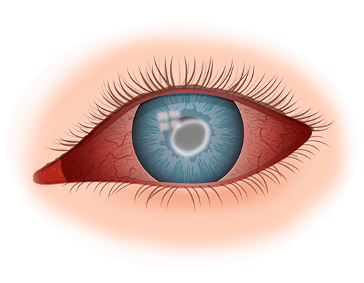 Uveitis Treatment in Buffalo