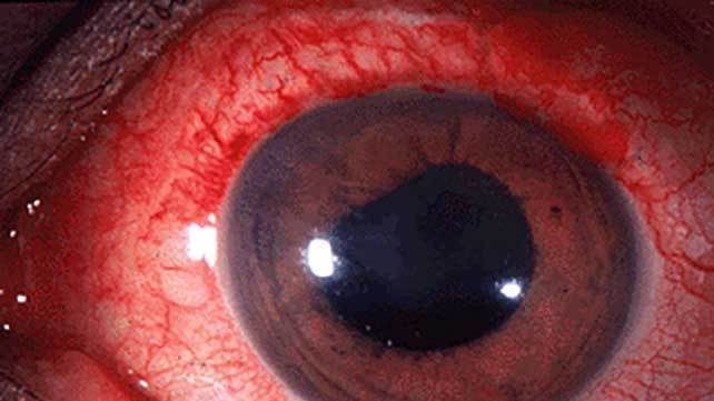 Uveitis Treatment in Buffalo 