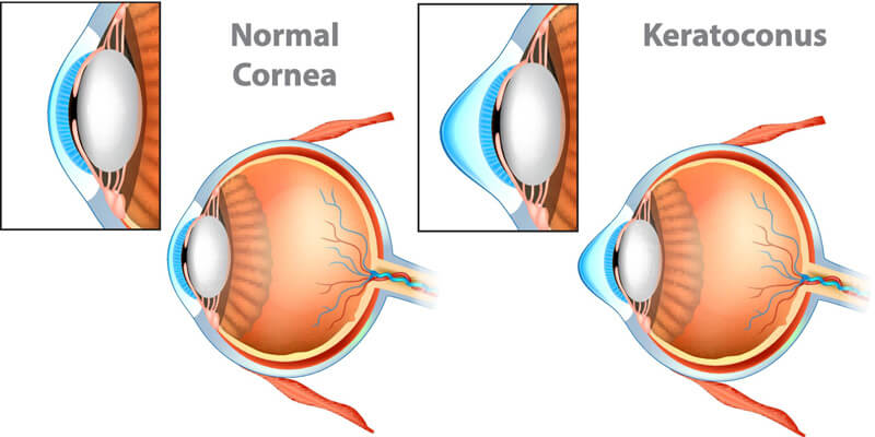 Cornea Transplant near me 