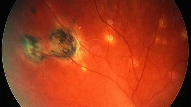 Uveitis Treatment in Buffalo