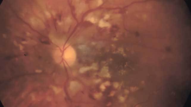 Buffalo Uveitis Treatment 