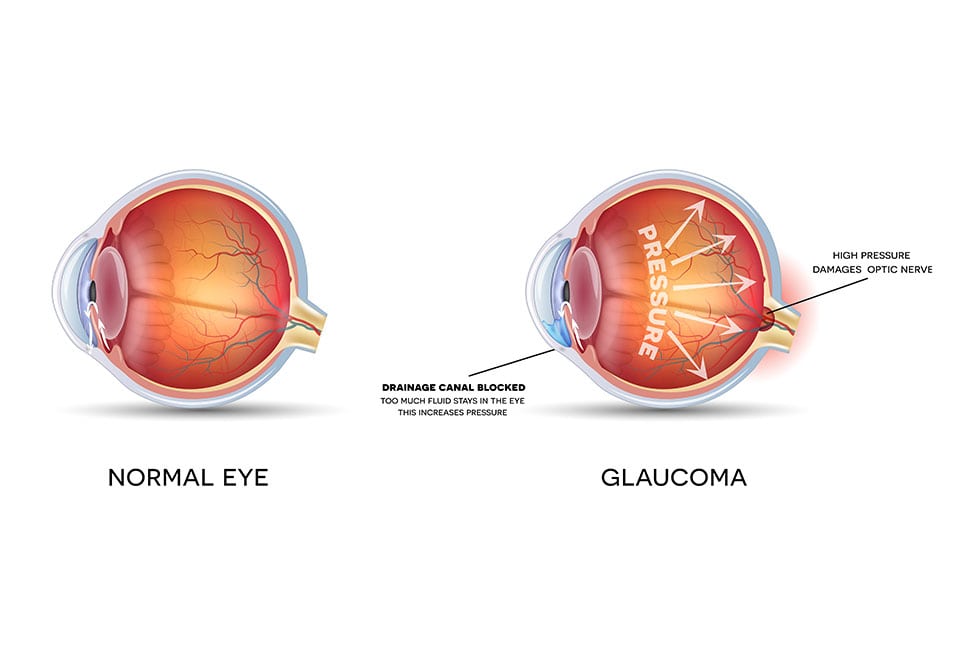 Normal Eye and Glaucoma
