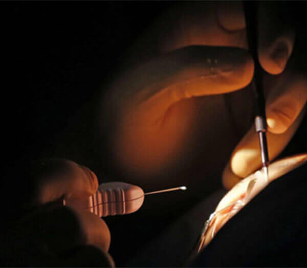 Doctor performing eye surgery